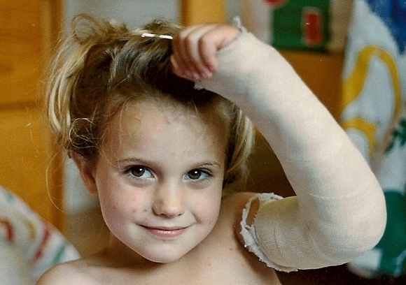 Little girl with broken arm & chicken pox marks. Photo by BF Newhall