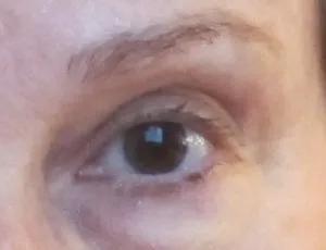 Barbara Falconer Newhall's left eye prior to cataract surgery. Here eyes are brown. Photo by Barbara Newhall