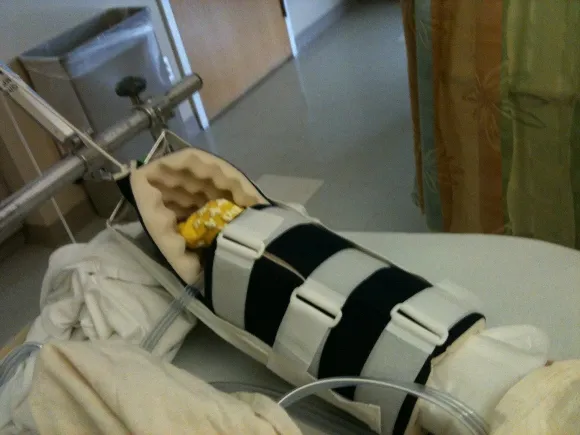 Leg cast for a woman, 92, with broken hip. Photo by BF Newhall 